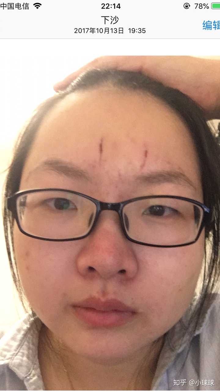 眉心还是很多痘痘～ 这时候脸颊两侧皮肤还不算太差