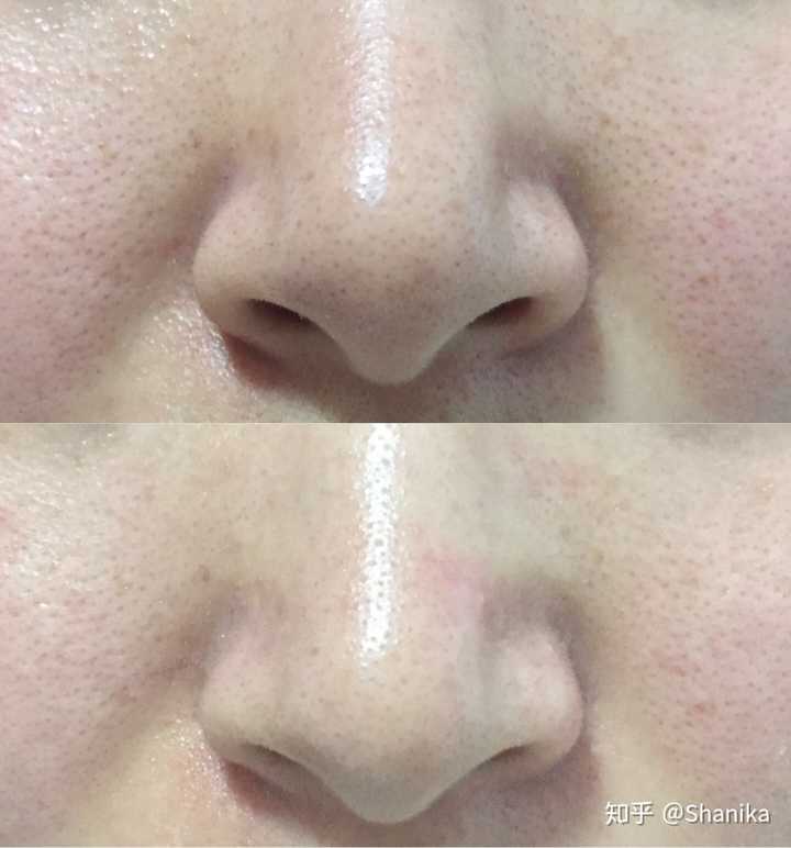 黑头多,毛孔大?
