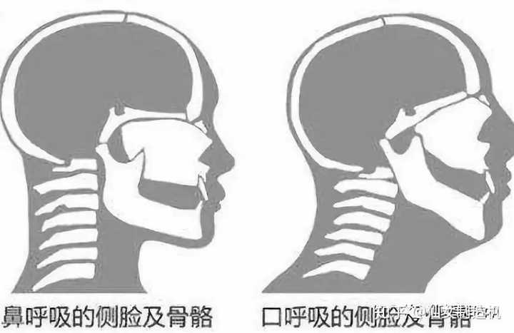 长期用口呼吸,对人的外貌影响很大:下巴后缩,上牙弓窄,牙齿排列乱,头