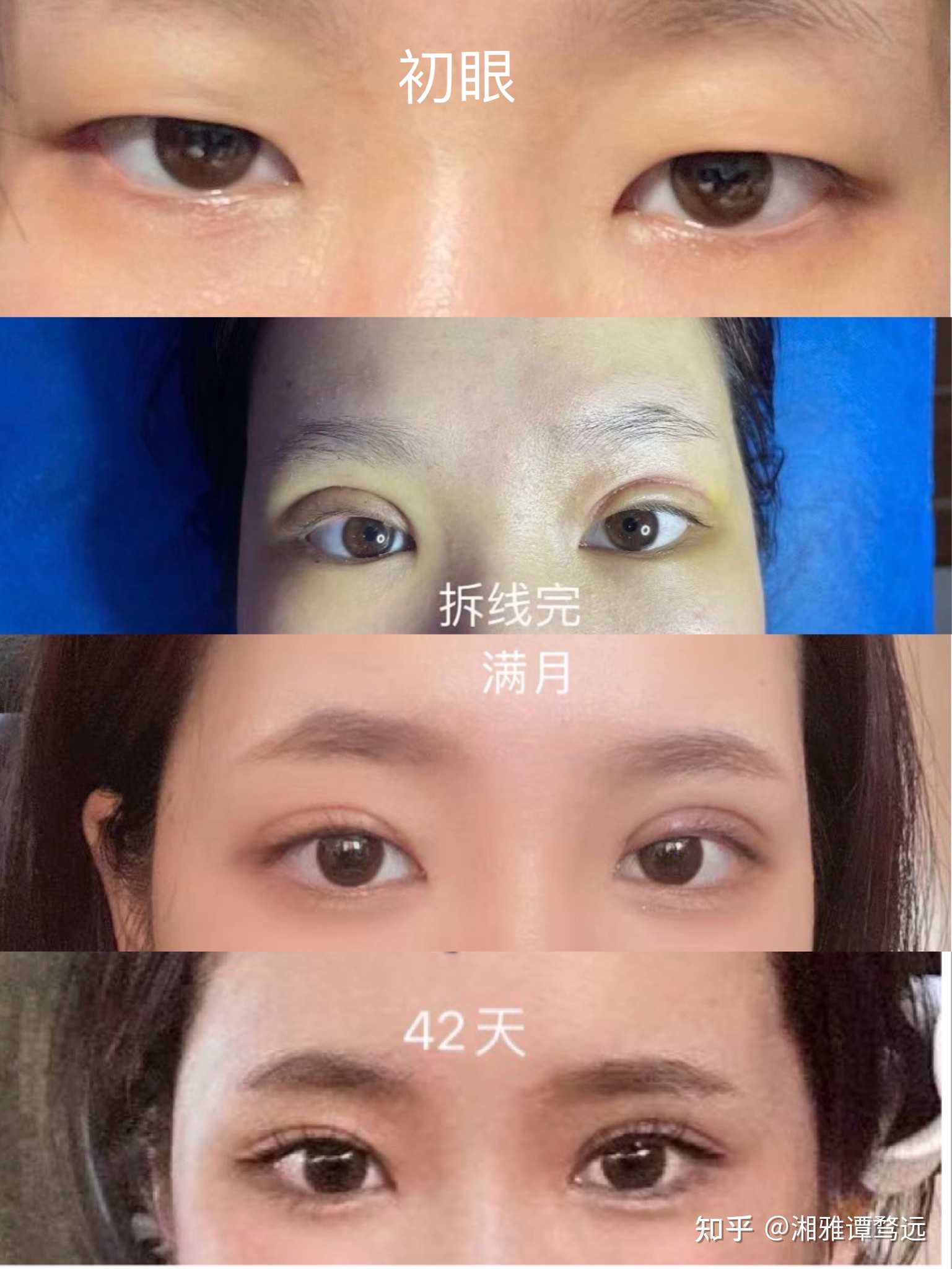 做双眼皮恢复期不对称怎么办
