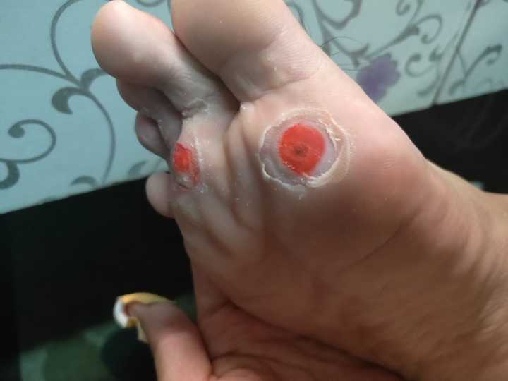 你是如何治好脚上长的鸡眼的?