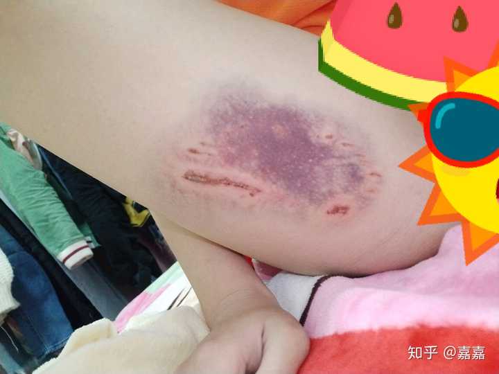 昨天和狗玩的时候狗不小心咬到了,一瞬间牙印都青了,唉,大冷天陪它玩