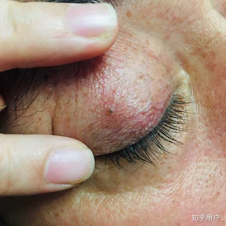 黑头油脂粒很多怎么办,毛孔粗大有油脂粒怎么办