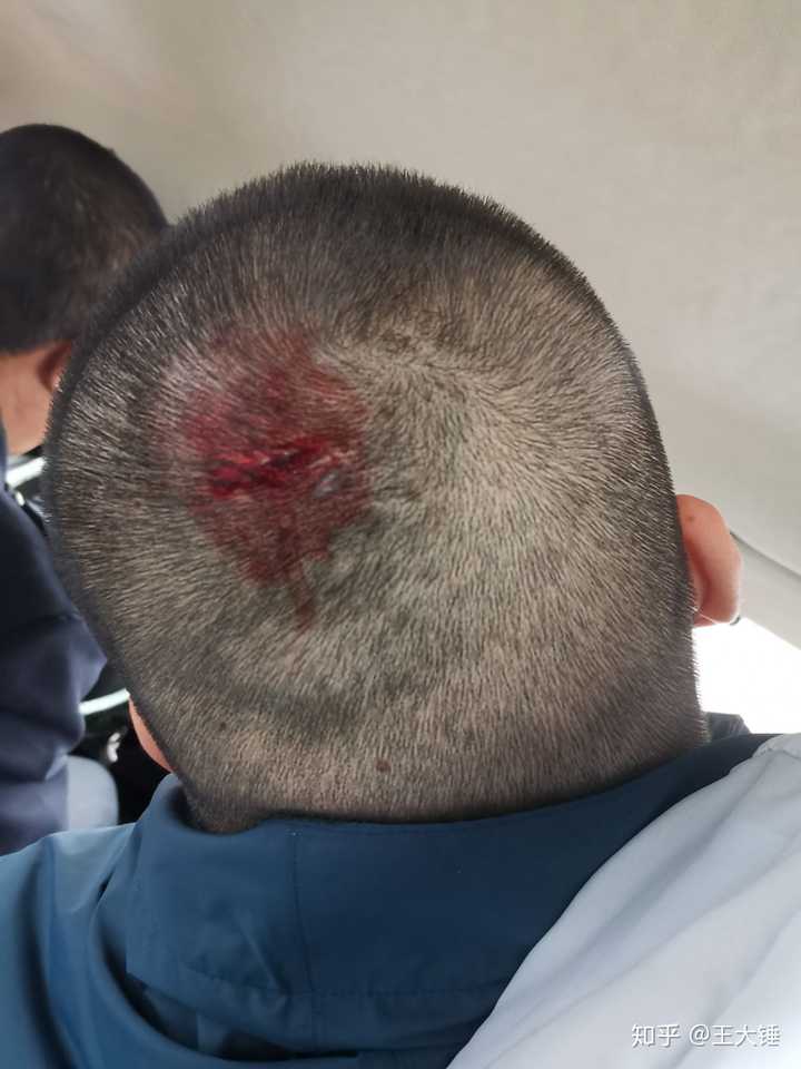 缝针和拆线可怕吗疼吗你们当时怕吗