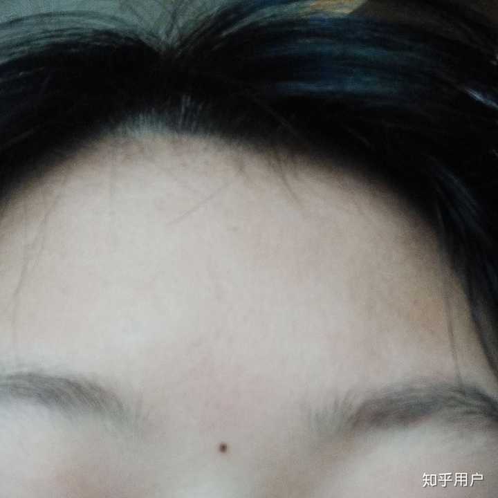 我想知道有多少人长了美人痣啊?