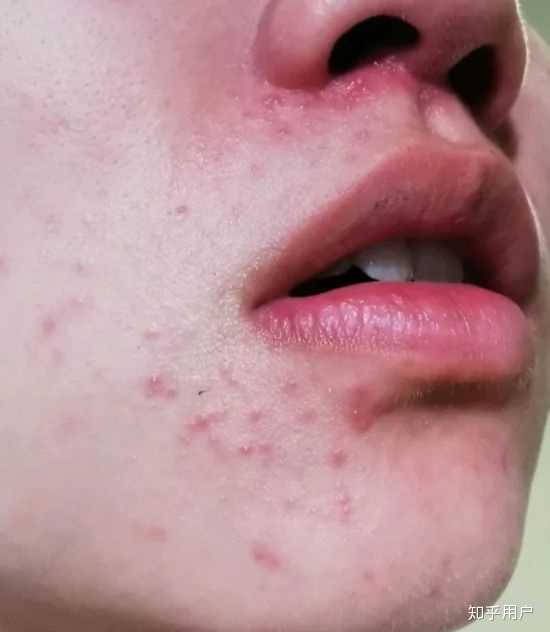 二十岁最近脸上长痘痘,求大神救援?