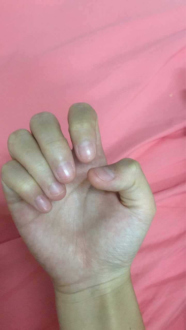 手指甲被咬的超级短怎么办?