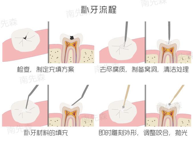 得了龋齿,什么情况可以直接补牙,什么情况又需要做根管治疗?