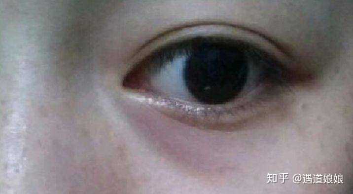 ▼ 血管型黑眼圈  ▼