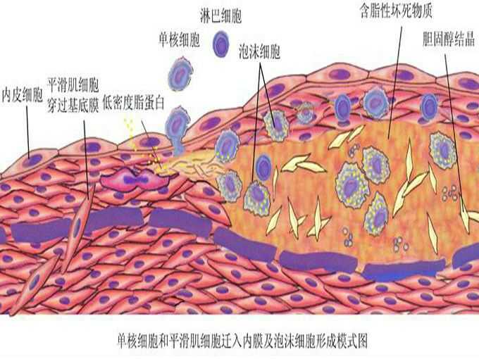 其胞浆中含有许多脂滴,是动脉粥样硬化斑块内出现的特征性病理细胞