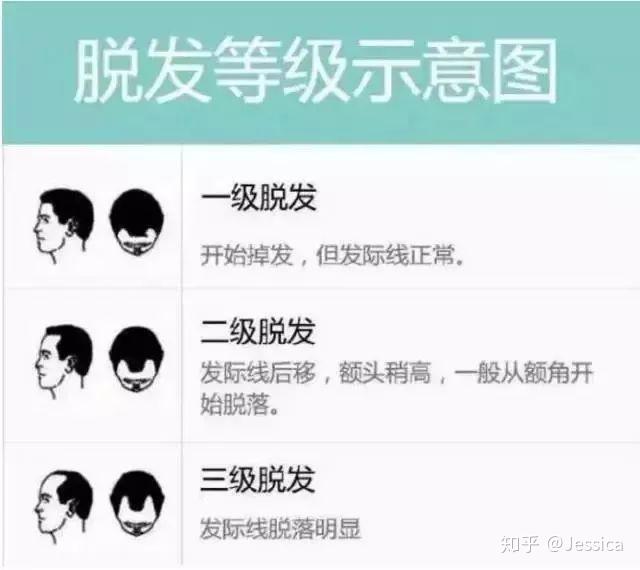 一级和二级属于轻度脱发,三级四级属于严重脱发,四级以后便属于秃头