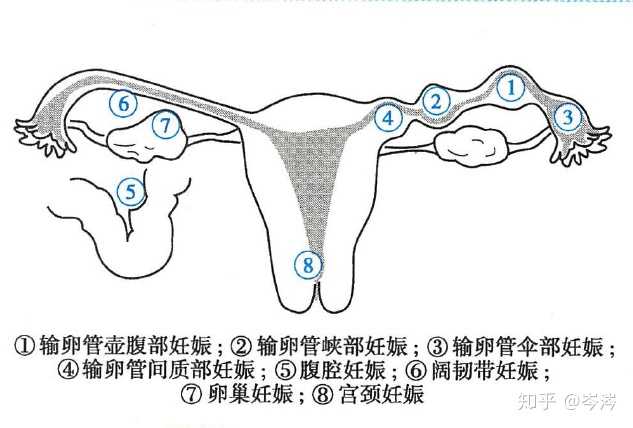 宫外孕也叫异位妊娠,出现异位妊娠最多的位置是 输卵管妊娠中壶腹部最