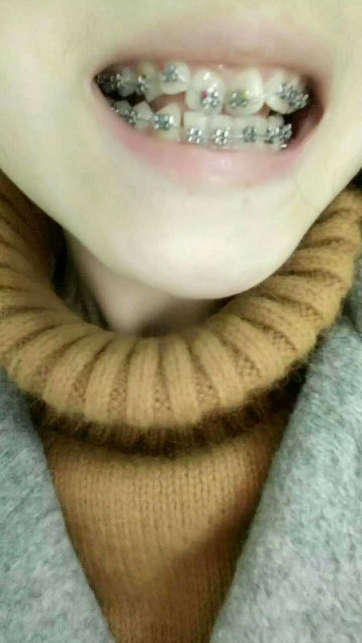 各位摘下牙套的那一刻是什么感觉?