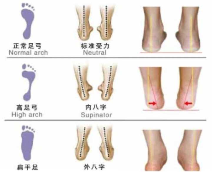 不良腿型导致足部受力不均