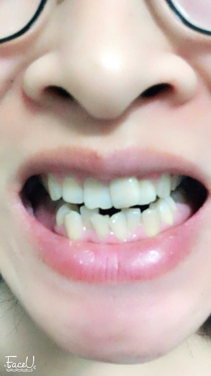 牙不齐(倾斜,拥挤)是怎样的体验?