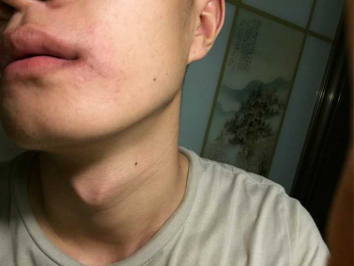 芒果过敏是一种怎样的感觉?
