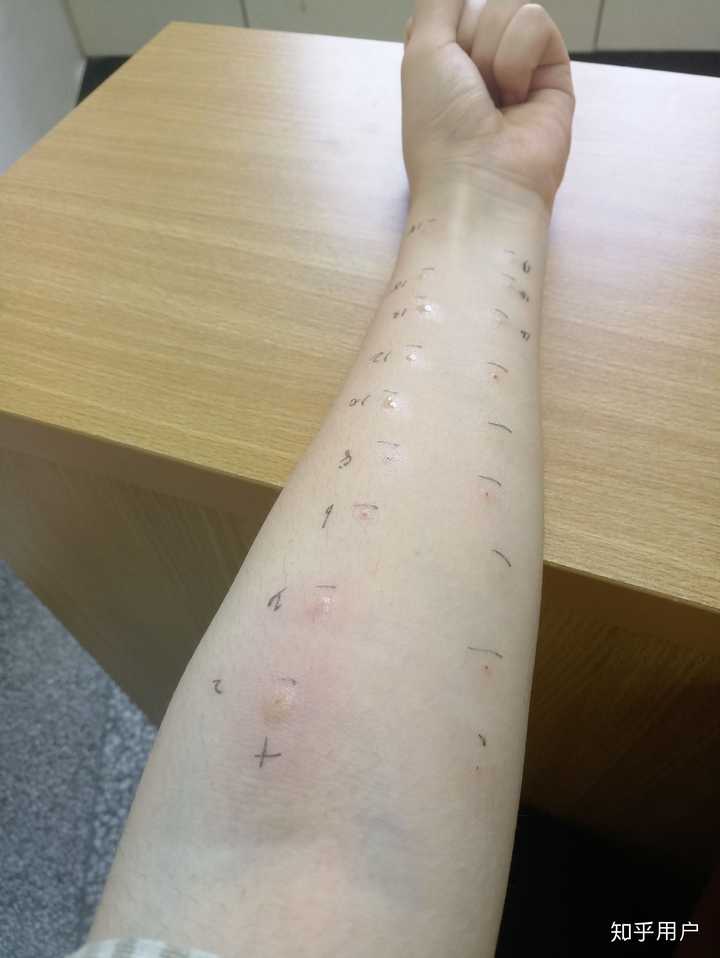 跟体质和皮肤的抵抗力很有关系 顺便来解释一下点刺的流程啦,我当时