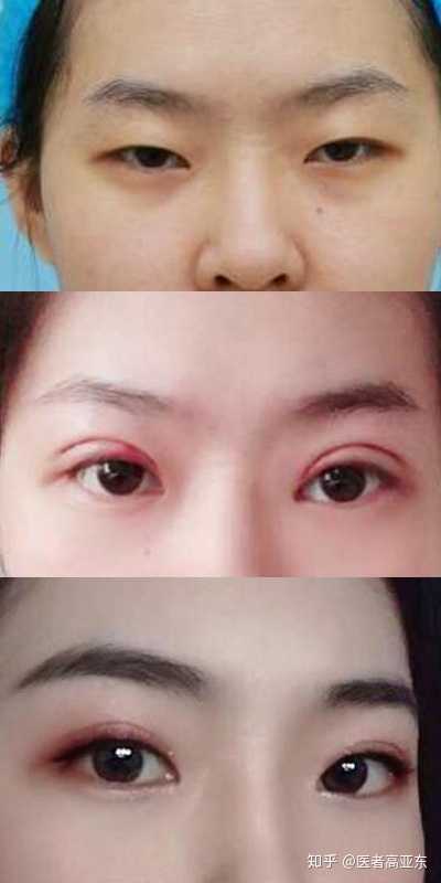 可以解决双眼皮存在的许多复杂问题,如上睑皮肤松弛,睫毛内翻,上睑