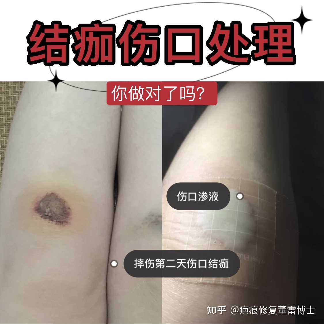 疤痕修复董雷博士 的想法: 【结痂伤口处理,你做对了