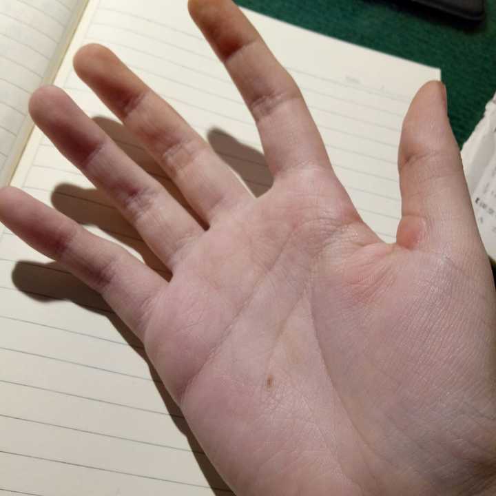 掌心有痣是什么体验?