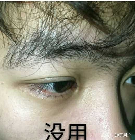 怎么去除这个黑眼圈 ?