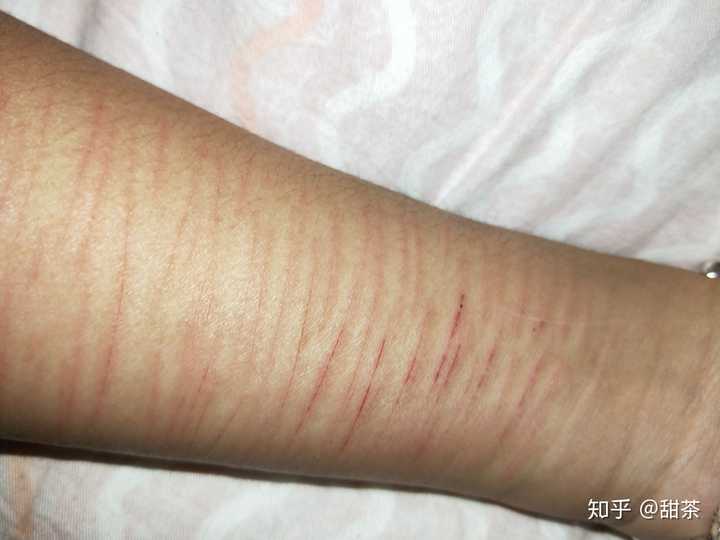 自残的人在自残后会后悔吗?