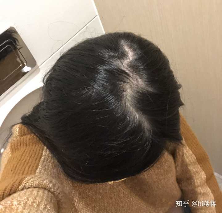 女生头顶头发少是什么体验 ?