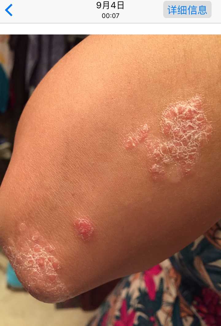 女生得了牛皮癣是一种什么体验?能治好吗?