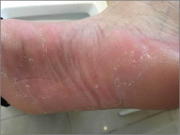 水泡型脚气和汗疱疹的区别?