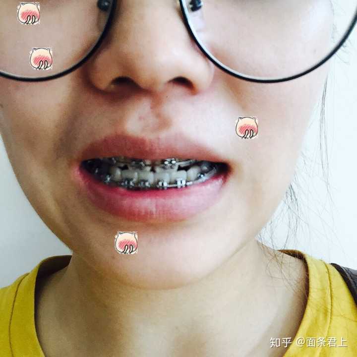 戴牙套(正畸)是什么体验?