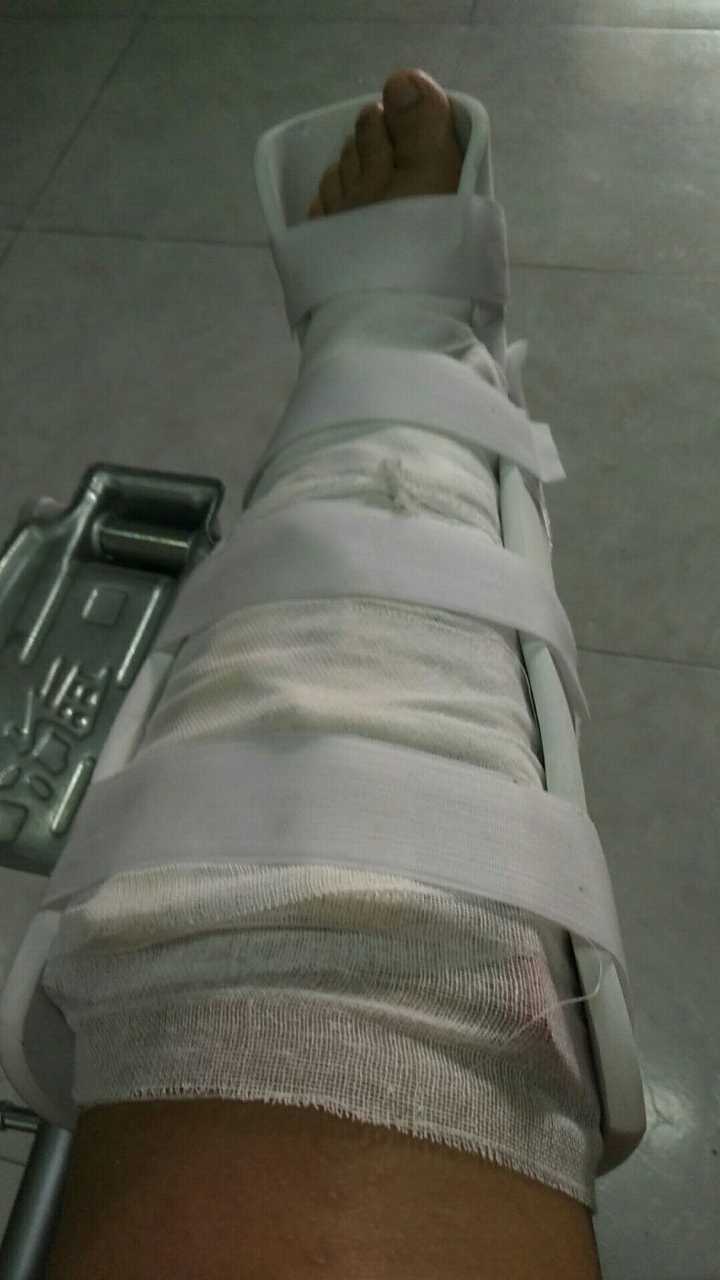 骨折是一种什么样的体验?