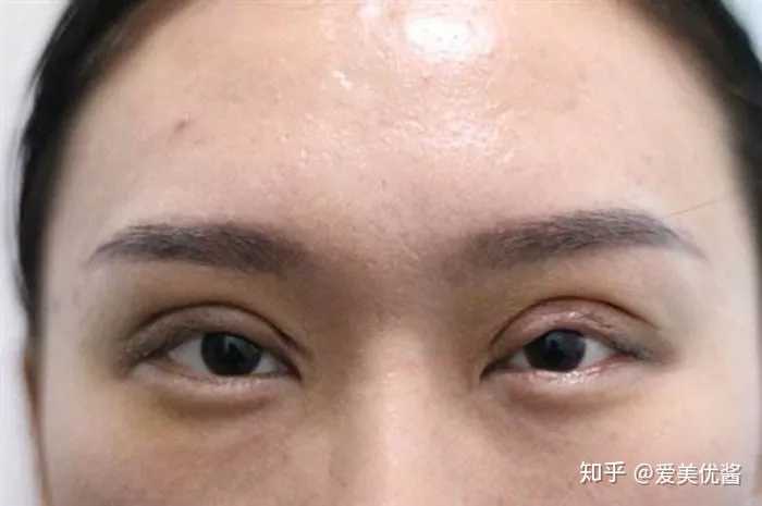 双眼皮手术后为什么会出现难看的