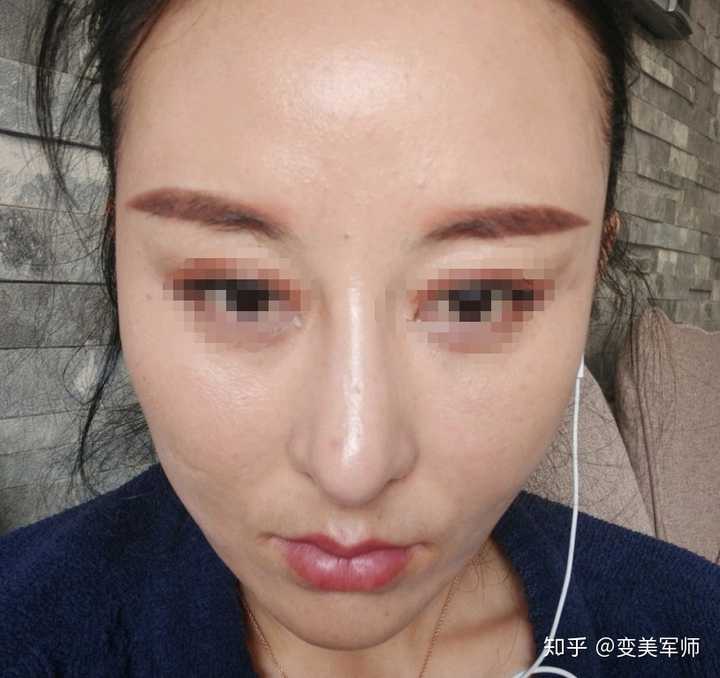 鼻尖下垂,鼻子过长