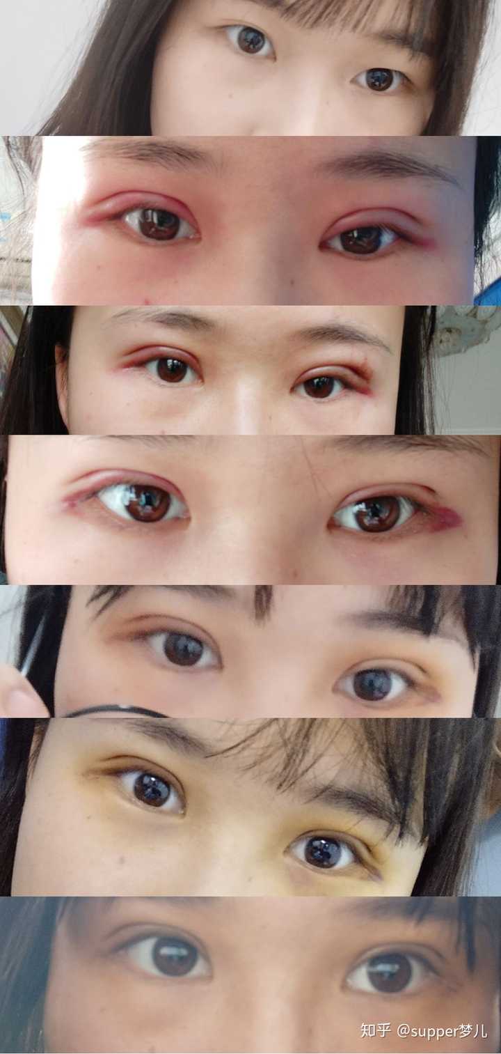 双眼皮对容貌有多大的改变?