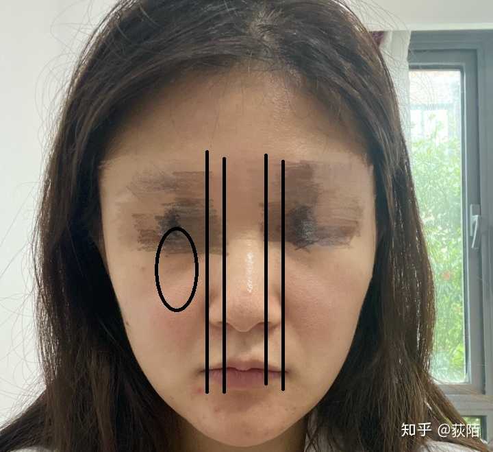 鼻头大鼻翼宽怎么办?