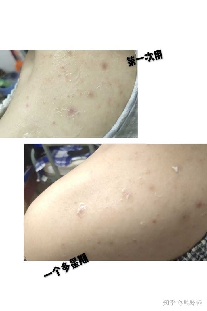 19岁毛孔粗大,用马油皂洗,每天洗的都很仔细,但还是会