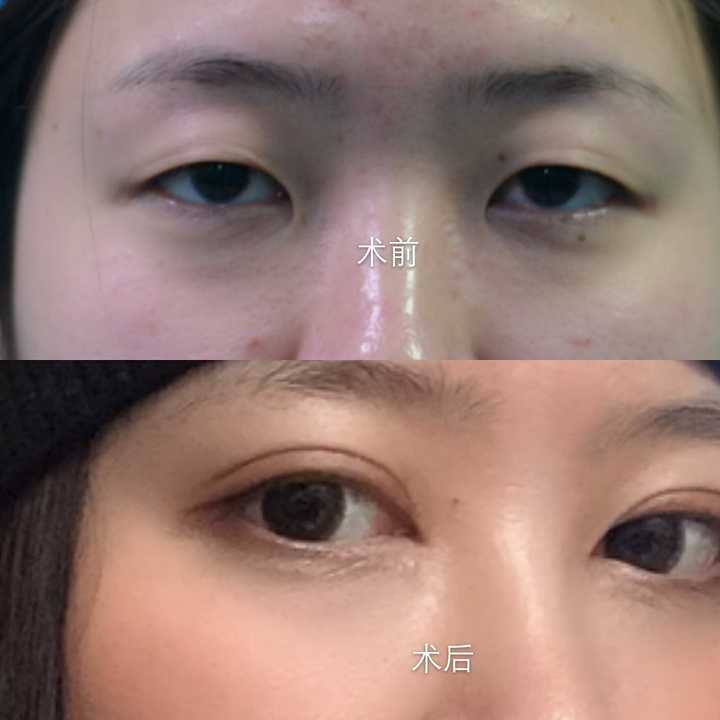 全切双眼皮 开眼角后用芭克会让双眼皮褶皱变浅吗?