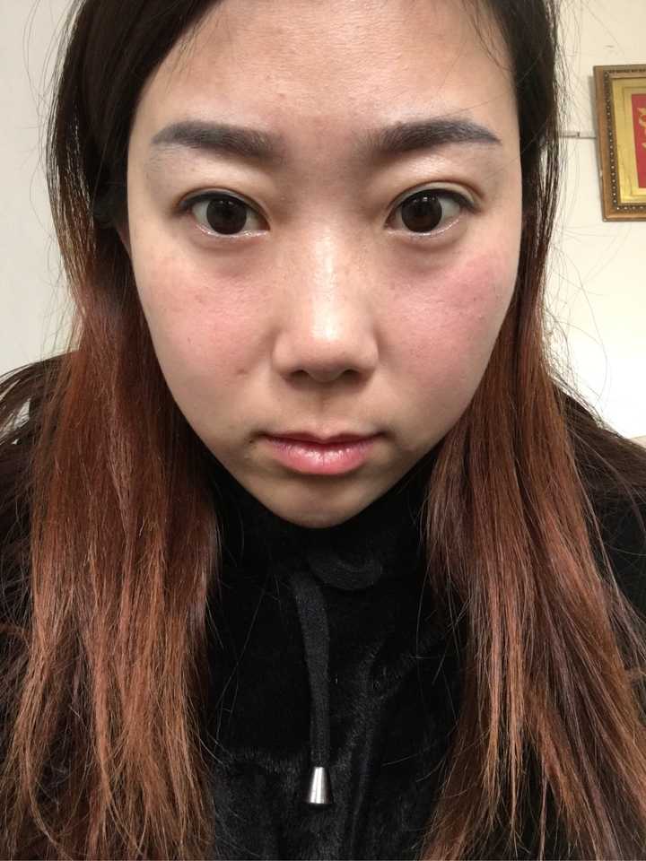 眼睛一大一小,脸也一大一小,嘴也是歪的,埋线的双眼皮很丑,我还不到30