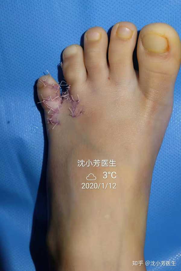 足趾的多趾并趾最好手术时间是一岁走路前,10个月左右,皮肤松弛植皮