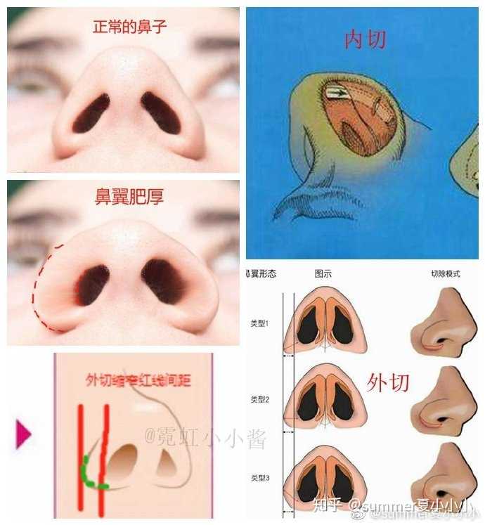 单纯缩鼻翼可以改善我的五官吗?