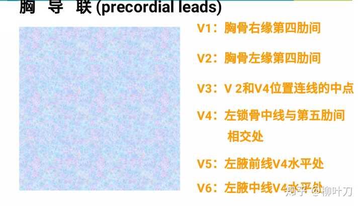 v2:胸骨左缘第四肋间 v3:v2与v4连线的中点 v4:左锁骨