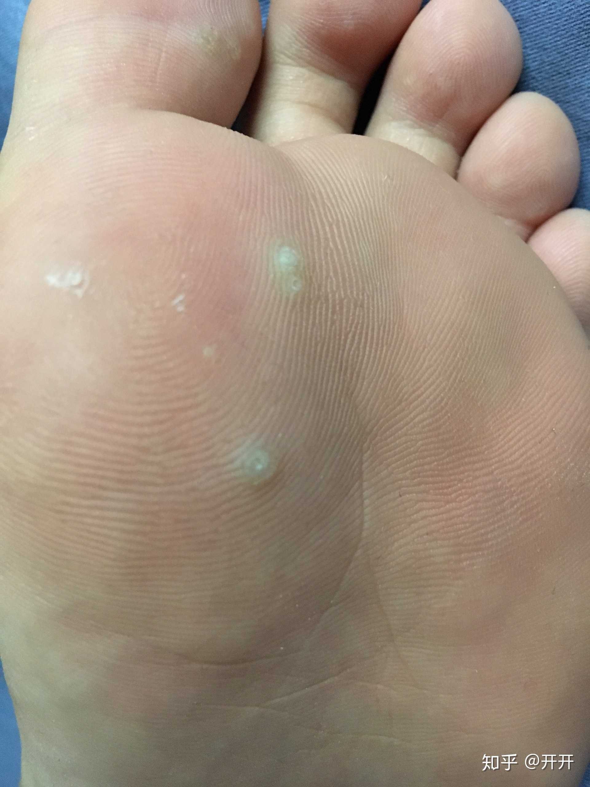 鸡眼贴使用过程