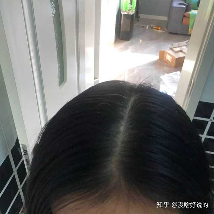 请问女孩子散开头发头顶是这样的算秃吗?