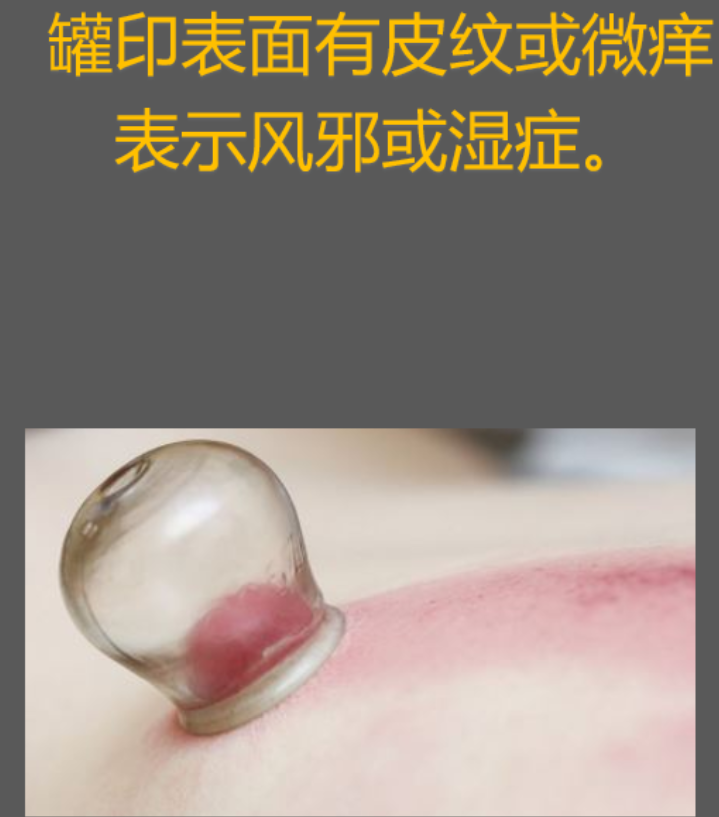 拔罐后皮肤的颜色越深湿气越重吗?