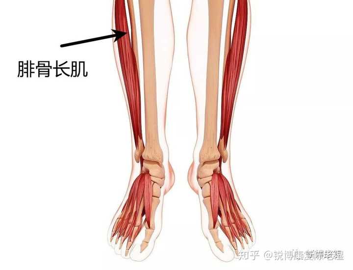 1 小腿内外侧肌肉力量不平衡 内侧胫骨后肌力量差,外侧腓骨长肌力量