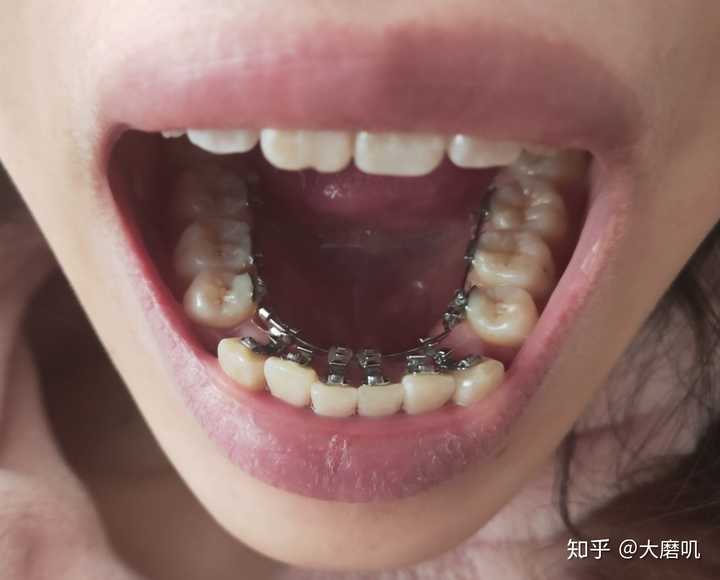 既然牙槽骨具有终生改建的能力,为什么拔牙正畸还是拯救不了骨性突嘴?