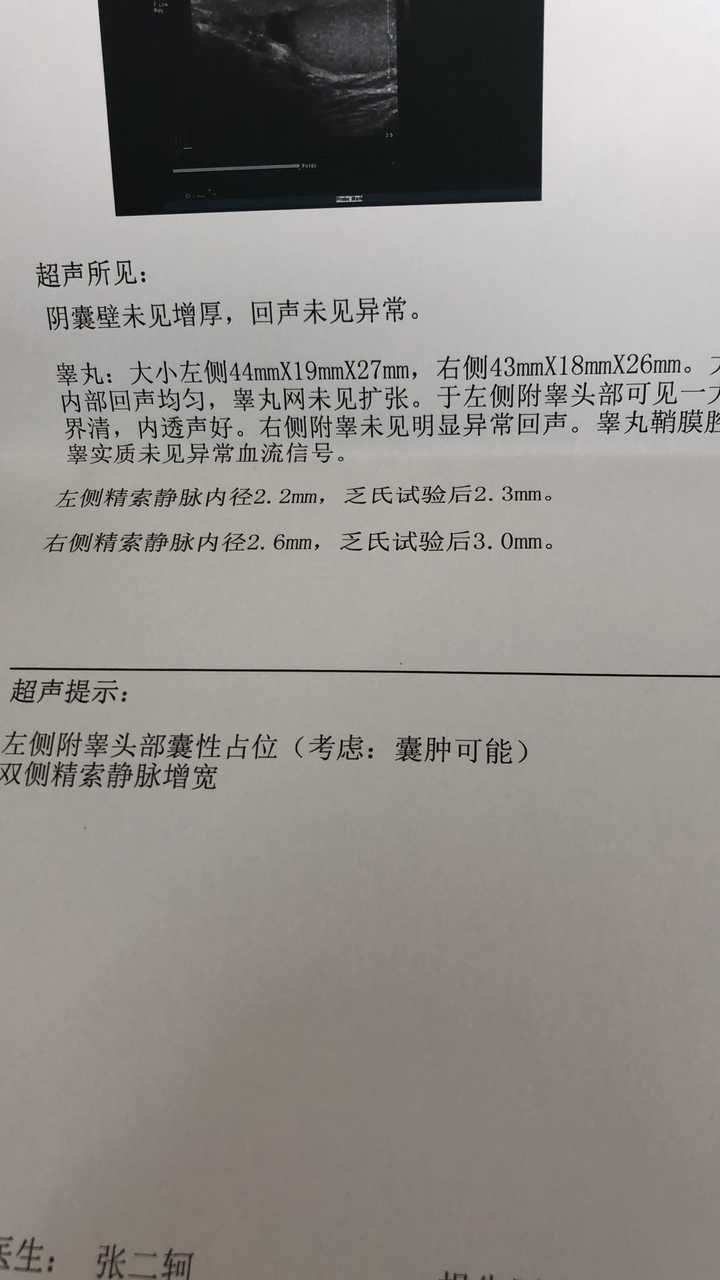 精索静脉曲张怎么办?