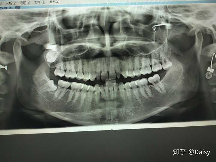 19年12月 洗牙后拍的牙片