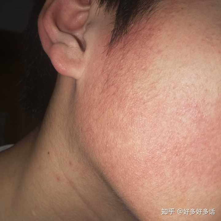 毛周角化怎么改善?