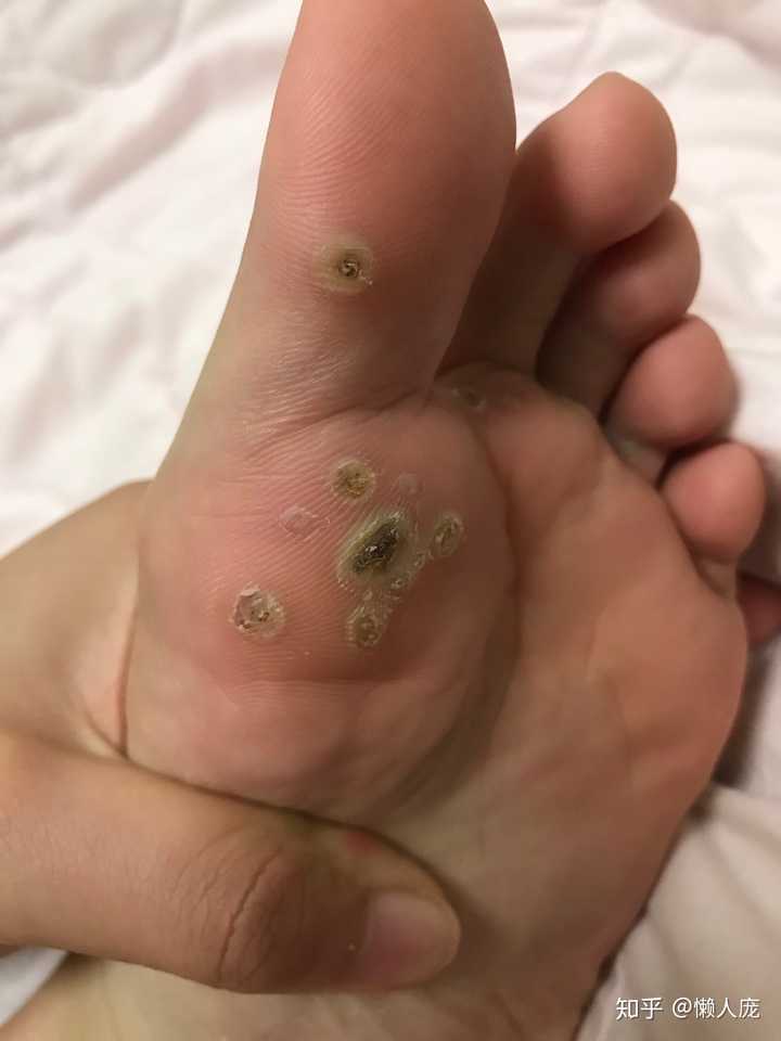 脚上感染长了疣,怎么弄.
